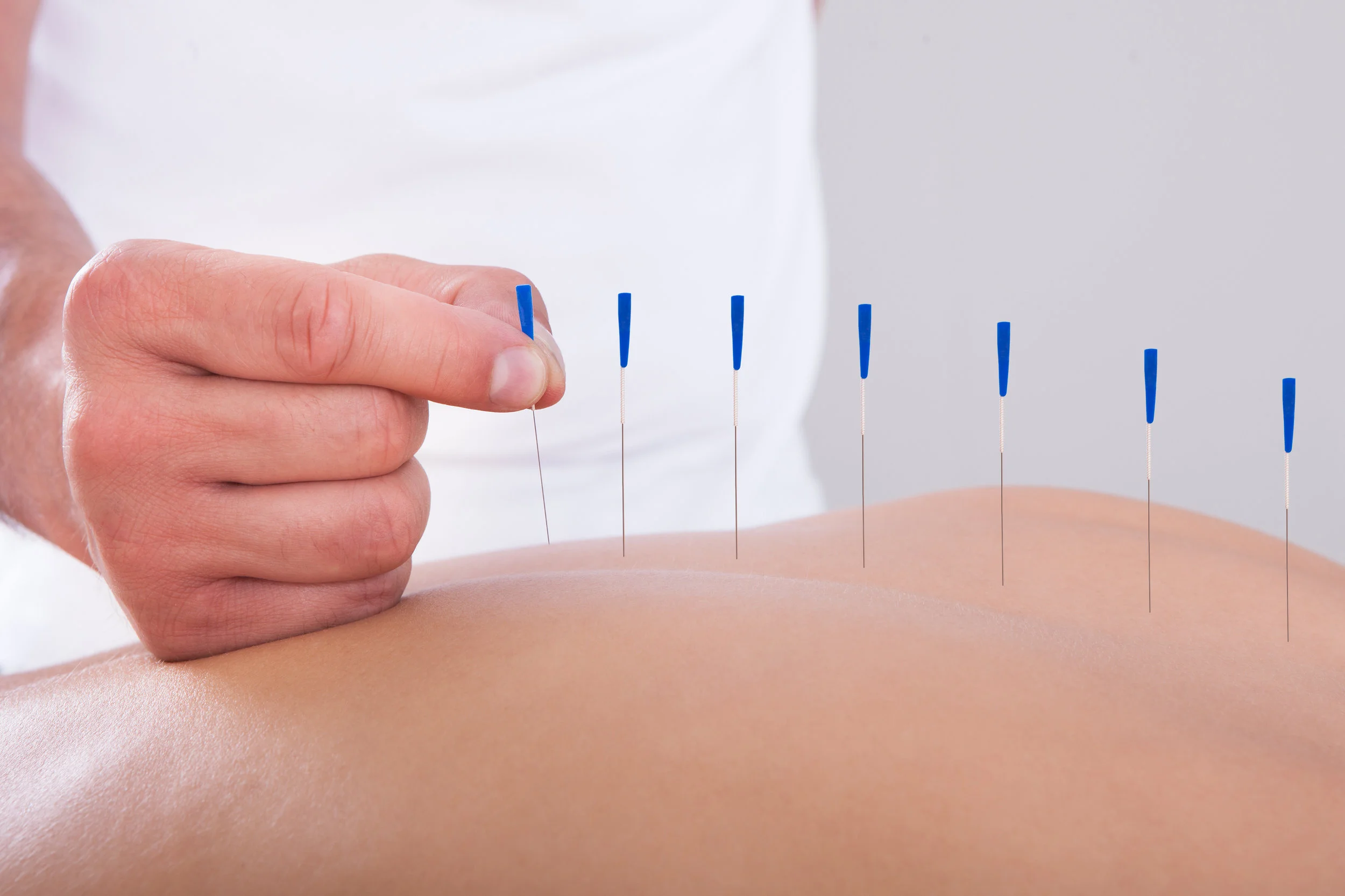 Apa Itu Akupunktur? What Is Acupuncture? 什么是针灸？